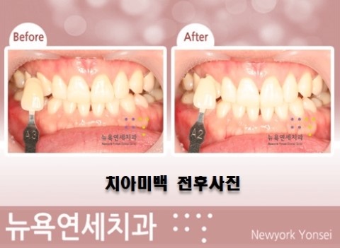  당일치아미백,당일미백,원데이치아미백가격,원데이치아미백치과