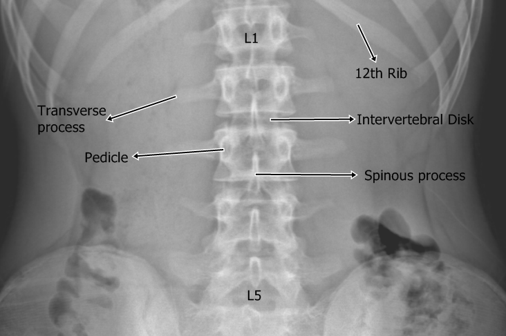 요추 (Lumbar ; 허리뼈) 해부학 : 네이버 블로그