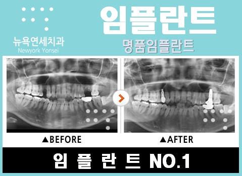  임플란트수술사진,임플란트수술,임플란트앞니수술,임플란트어금니수술
