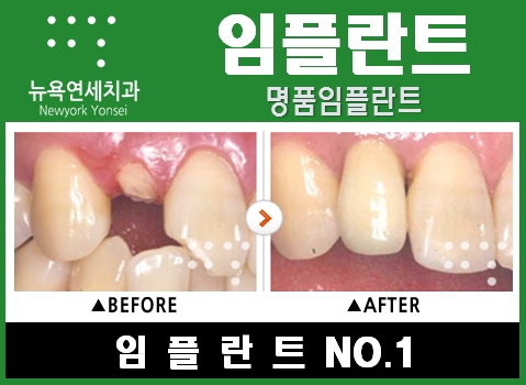  임플란트가격비교,임플란트가격,임플란트수술가격,임플란트제품가격