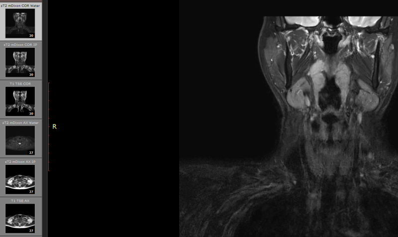 MRI 결과 집에서 살펴보기 / 뷰어 / Viewer : 네이버 블로그