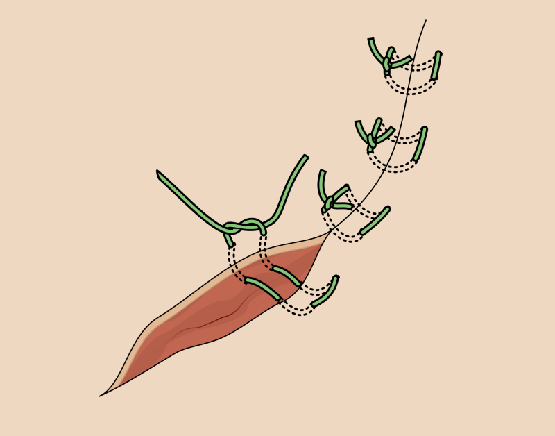 [부산포경수술흉터치료] 포경수술 흉터 9