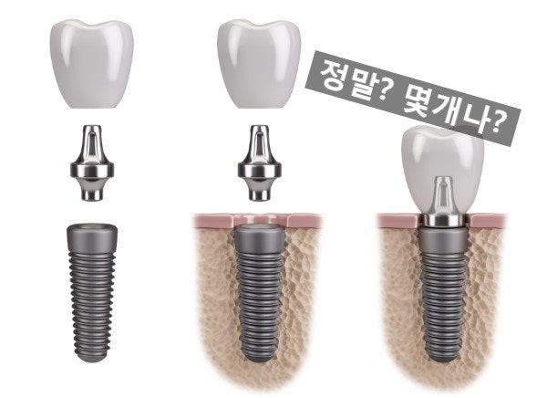 부산 임플란트 보험 적용 대상이 궁금해서요? 3