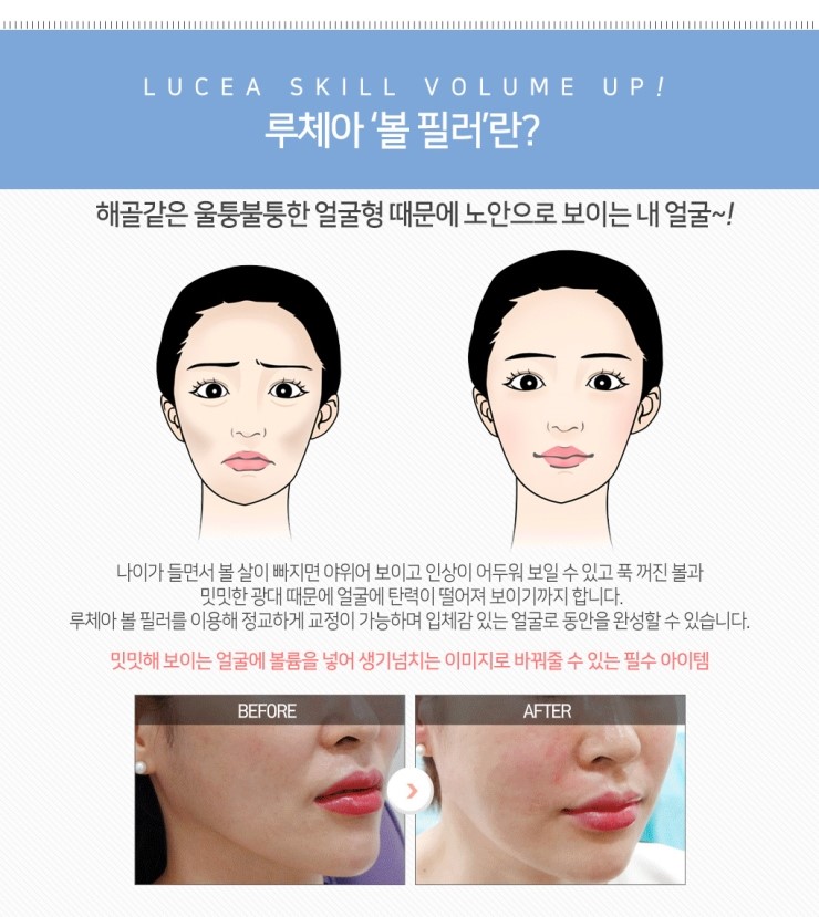 강남 볼살 빼당주사 얼굴살 때문에 6