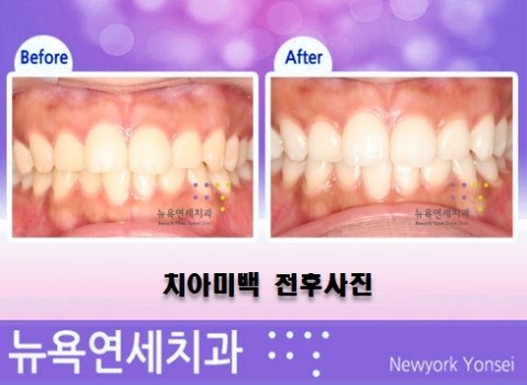  원데이치아미백과정,원데이치아미백,하루치아미백,원데이치아미백효과