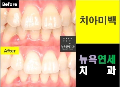  미백치과,치아미백병원,치아미백종류,치아미백시술