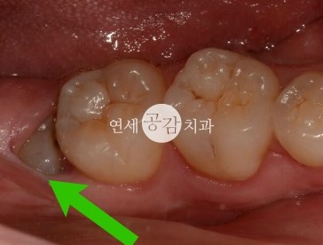 사랑니 발치 비용 간단요약 정리 네이버 블로그