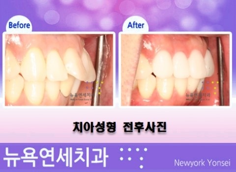  돌출입치아성형,돌출치아성형,돌출앞니성형,돌출앞니치아성형