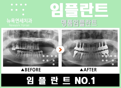  임플란트방법,임플란트치료,임플란트치료방법,임플란트수술방법