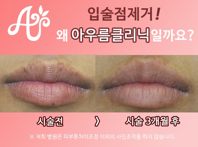 [분당펄피부과] 점제거 고난도 입술점 제거 흉터없이 제거하기 위한 방법은?