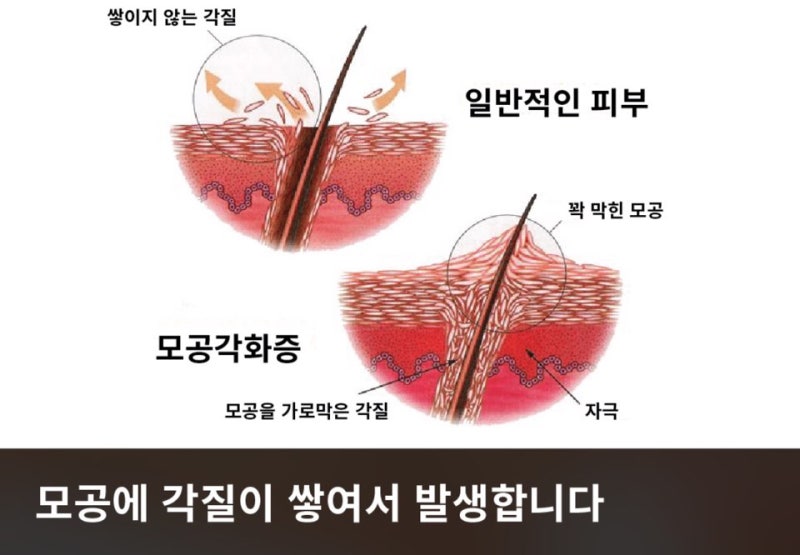 모공각화증의 원인을 분명히 끝내다