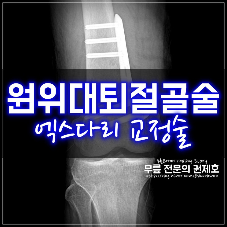  무릎 외측 연골 깨짐 엑스다리 : 원위 대퇴 절골술로 휜다리 교정 방법