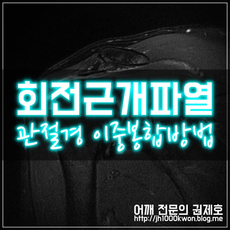  어깨 회전근개파열 : 어깨관절경을 이용한 회전근개 봉합 방법
