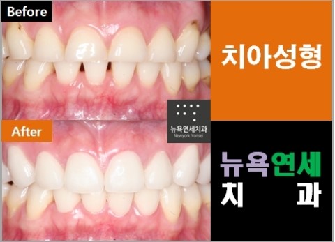  치아성형전문치과,치아성형,치아성형치과,치아성형병원