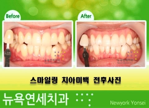  치아미백잘하는병원,치아미백병원,미백전문치과,미백추천