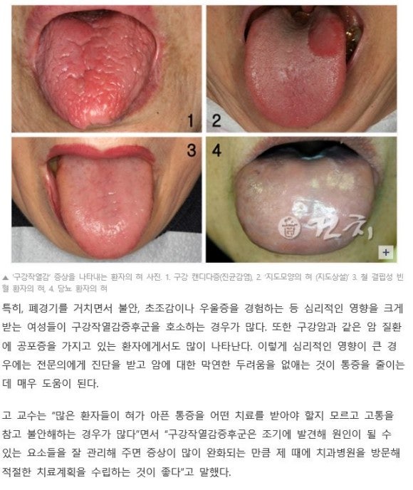 구강작열감증후군 혓바닥에 통증과 4