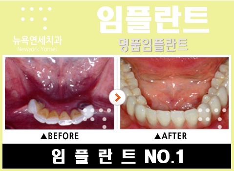  임플란트치아,치아임플란트,어금니임플란트방법,임플란트치료과정