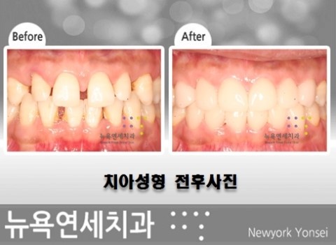  ###앞니교정시술,앞니교정,앞니라미네이트교정방법,앞니교정성형###