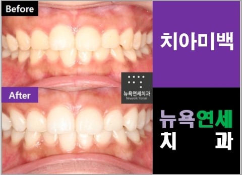  원데이미백,원데이미백치과,원데이미백비용,원데이미백병원