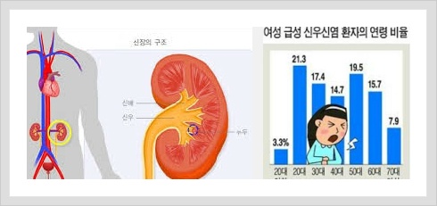 급성 방광염, 신우신염의 원인, 증상과 치료 9