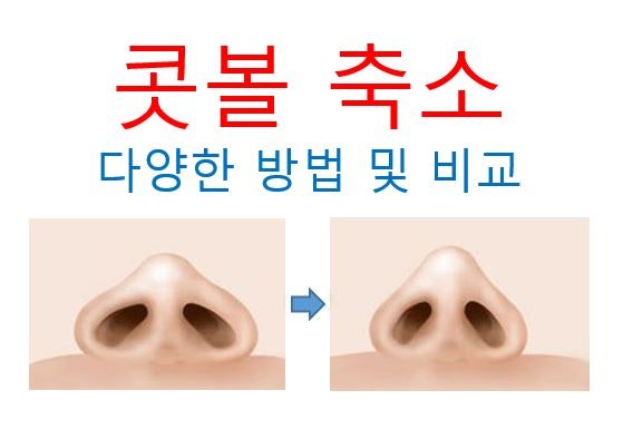 콧볼축소수술 다양한