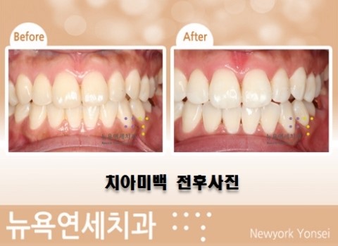  치아미백추천병원,치아미백병원,치아미백전문치과,치아미백유명한곳