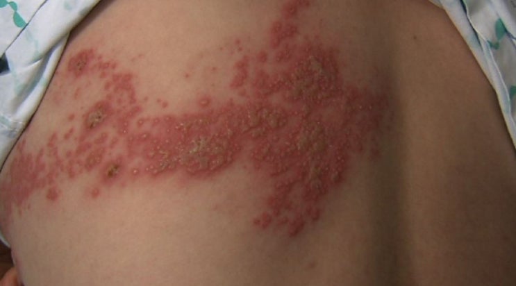  대상포진, 통풍, 피부병은 면역계의 자멸을 말한다. 자가 면역계 질환은 너무나 많다. 