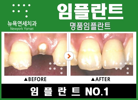  임플란트제품,국산임플란트,외국산임플란트,임플란트종류