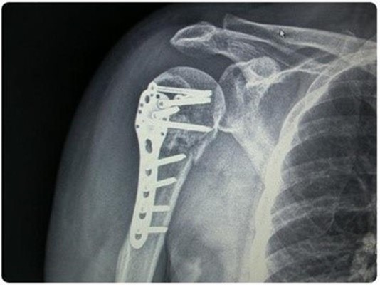 상완골 골절 후유장해 보상은 한가지가