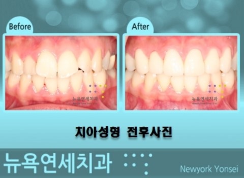  앞니치아교정치과,앞니치아교정,앞니라미네이트교정,앞니올세라믹교정