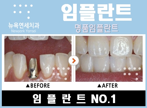  임플란트수술비,임플란트수술,임플란트치료비,임플란트치료과정