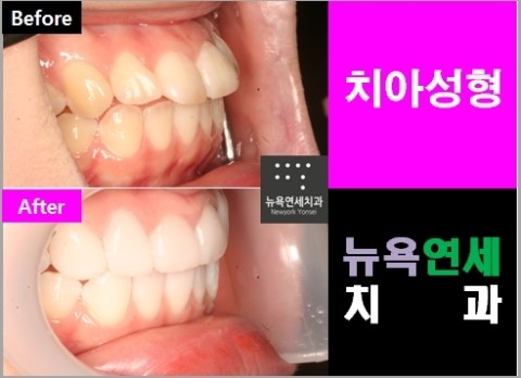  ##돌출앞니치아성형,돌출앞니성형,돌출앞니올세라믹,올세라믹앞니교정##