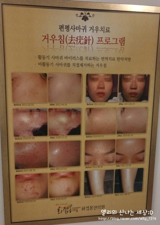 한의원에서 편평사마귀 제거하기 거우침 치료후기