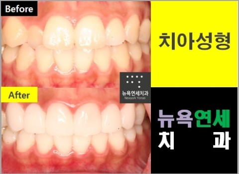  ##치아성형전후,치아성형사진,치아성형상담,치아성형병원##