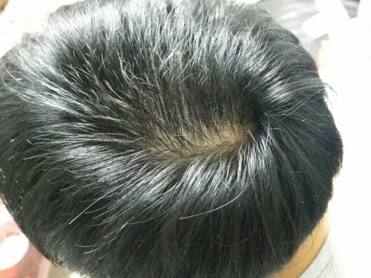  탈모 고민 끝 소갈머리여 안녕