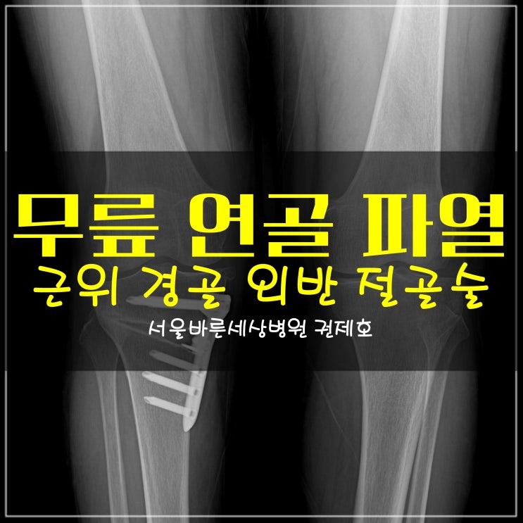 근위경골절골술 관절경 미세천공술 권제호무릎수술일지