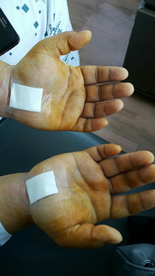 손목 터널증후군 수술후기.
