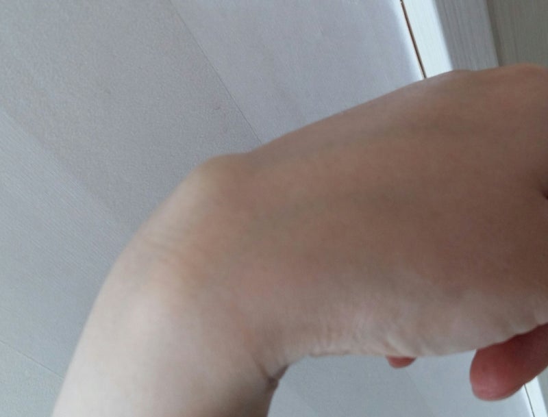 손목결절종 수술 대신 손목보호대로 나은 후기 13