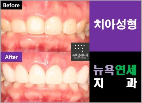  ##라미네이트치료,라미네이트치료방법,라미네이트제품,라미네이트전후##