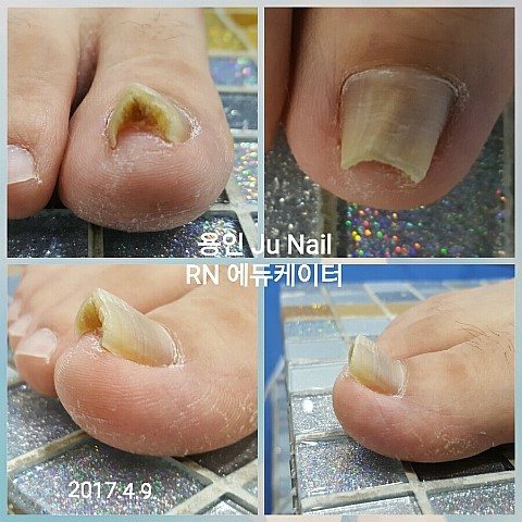 삼각형무좀변형/분당용인수지보정죽전동/주네일 삼각형무좀변형/분당용인수지보정죽전동/주네일