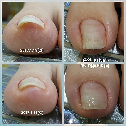 내향성발톱1회관리후~/분당용인수지보정죽전동/주네일 내향성발톱1회관리후~/분당용인수지보정죽전동/주네일