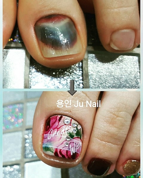 멍든발톱패디큐어/분당용인수지보정죽전동/주네일 멍든발톱패디큐어/분당용인수지보정죽전동/주네일