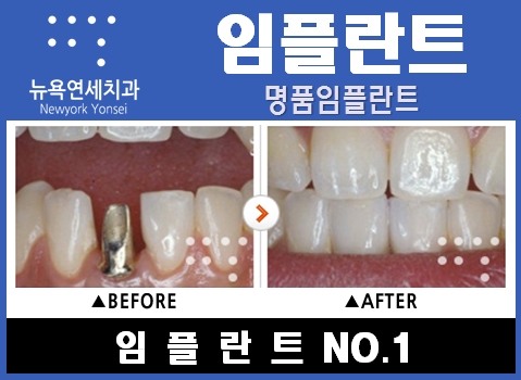  ##치과임플란트,임플란트병원비,임플란트상담,임플란트견적##