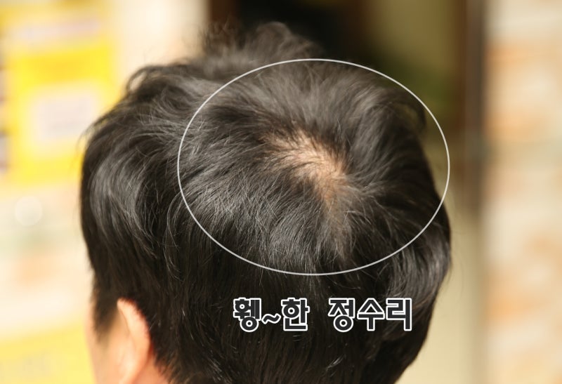 울산 남자가발, 정수리 탈모 맞춤가발로 완벽 보완! 3