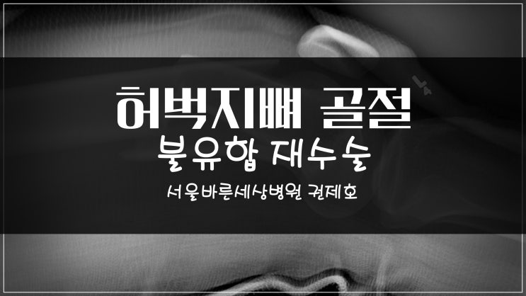  허벅지뼈 골절 불유합 재수술
