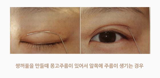 무흉앞트임