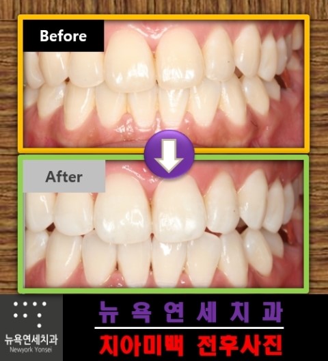  전문가치아미백,치아미백잘하는병원,치아미백치과,치아미백추천
