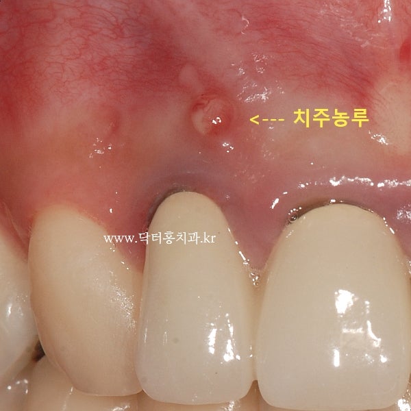 치은염의 고름에 대처하는 방법 3
