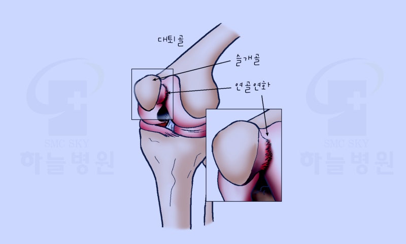 무릎속 통증 월배역성형외과 완쾌신경과 무릎점막염 치료