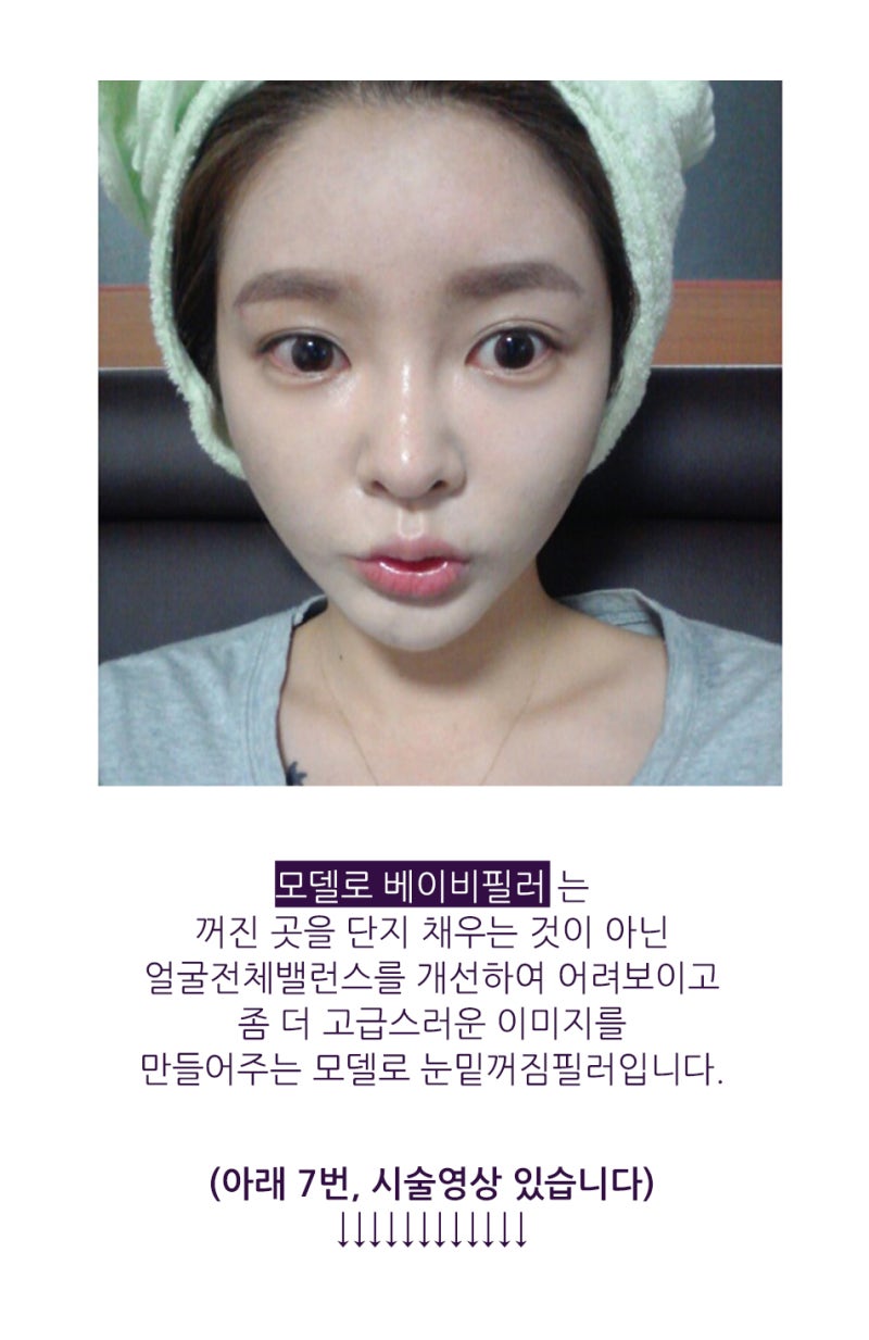 눈필러 수술 전 알아야 할 3가지